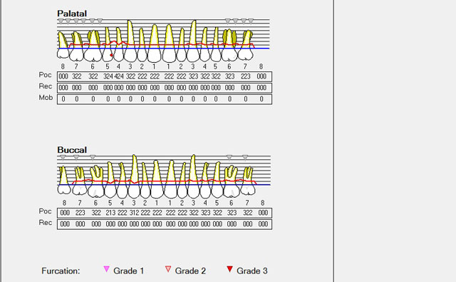 歯周ポケットのチェック
