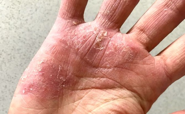 eczema1